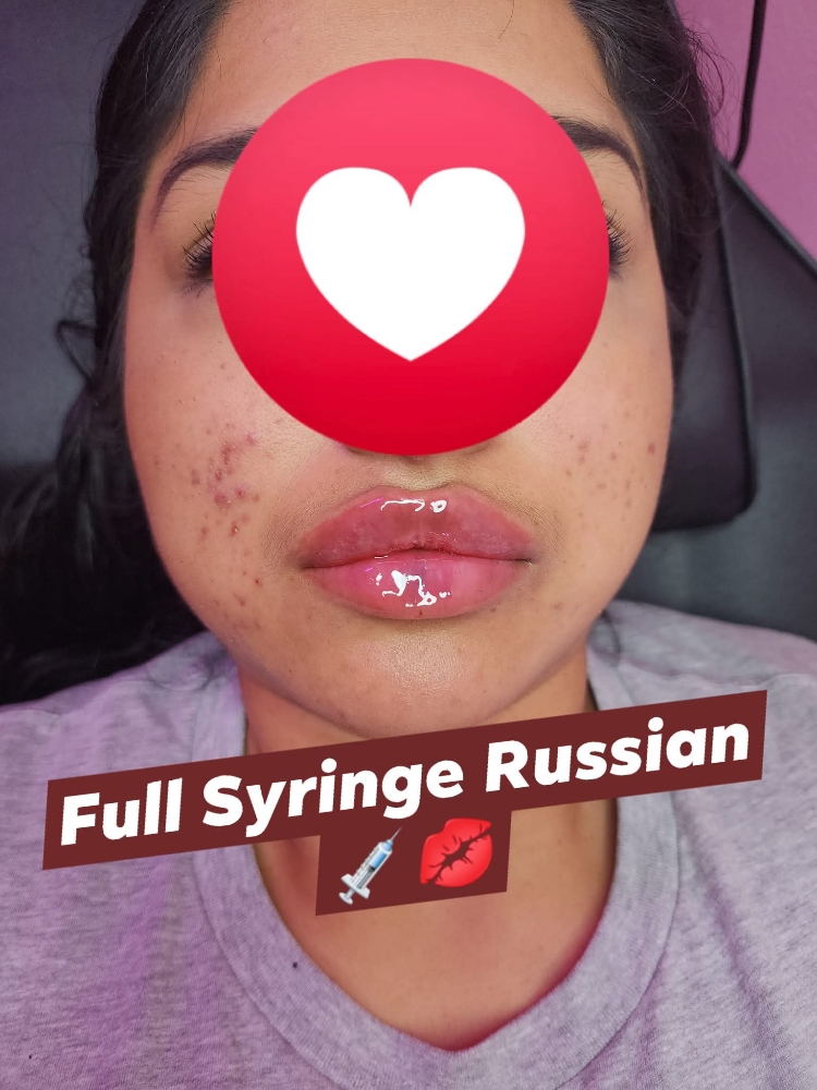 💉👄1ML Full Russian at Lavish Luxuries in Lubbock, TX