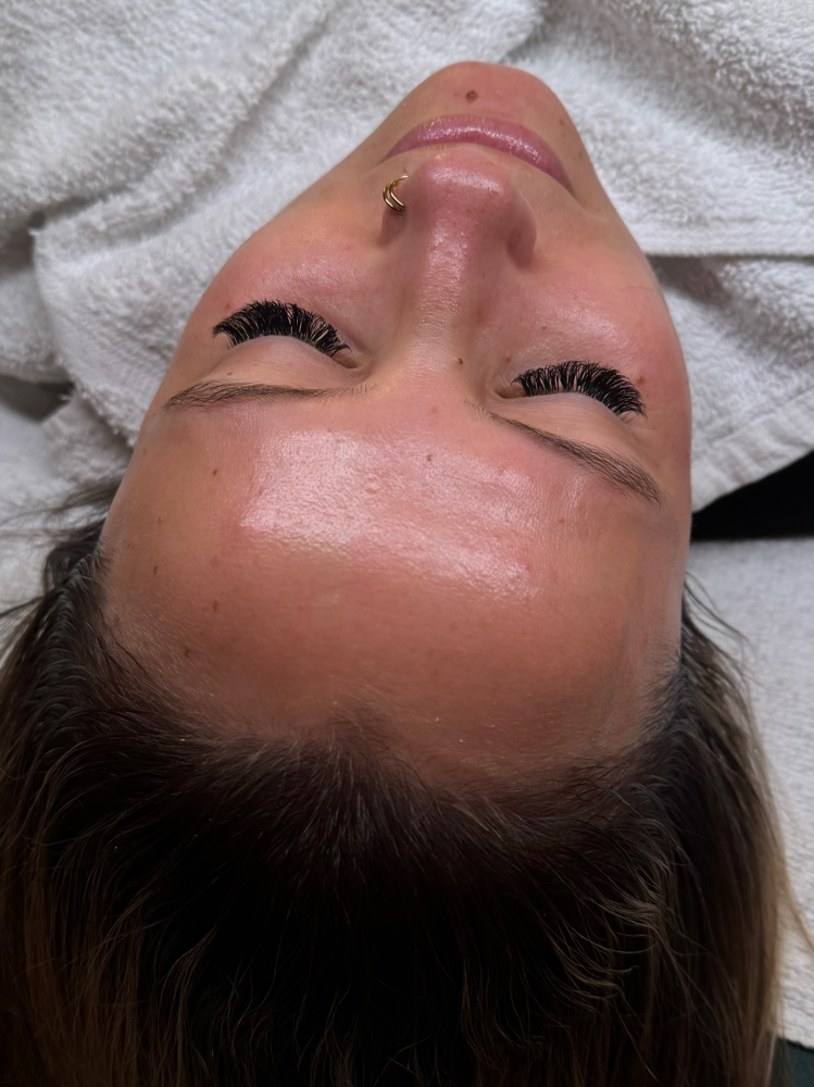 The Acne Healing Facial