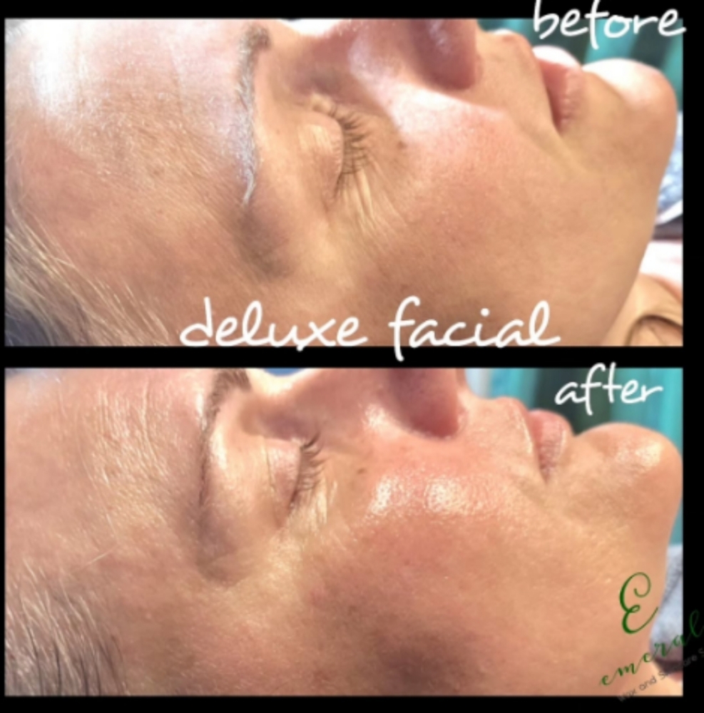 Deluxe HydroFacial
