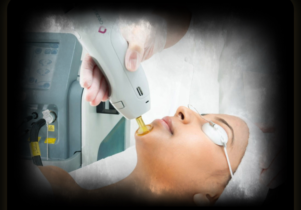 Candela skin tightening facial
