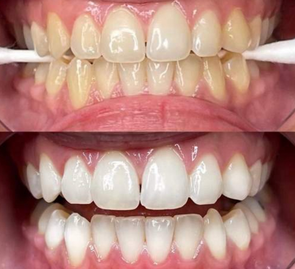 Professional Teeth Whitening