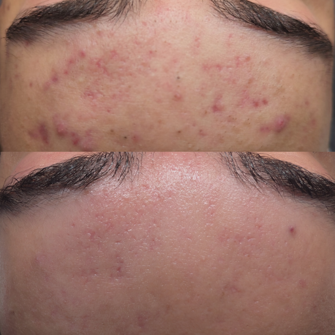 Acne Treatment