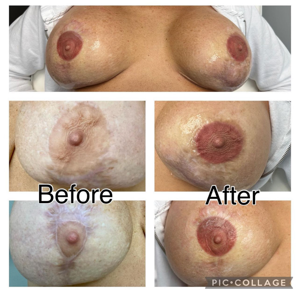 3D Restorative Areola Tattoo