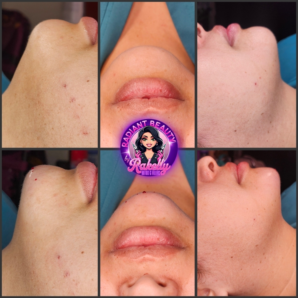 Chin Filler at Radiant Beauty By Rakelly LLC in Fort Worth, TX