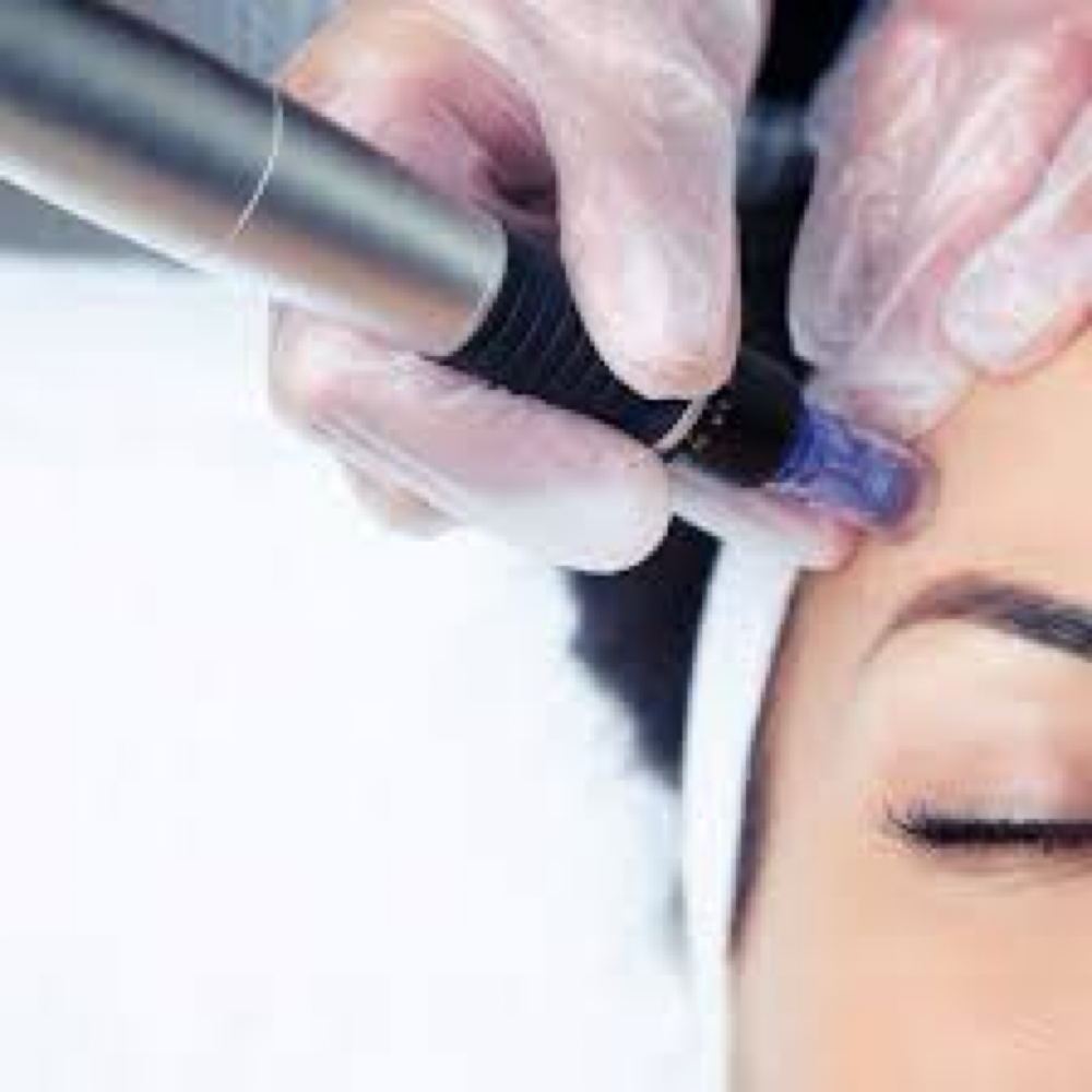 Acne + Pigment Corrective Needling at Melanie Fuller BB Skincare Inc in 28403