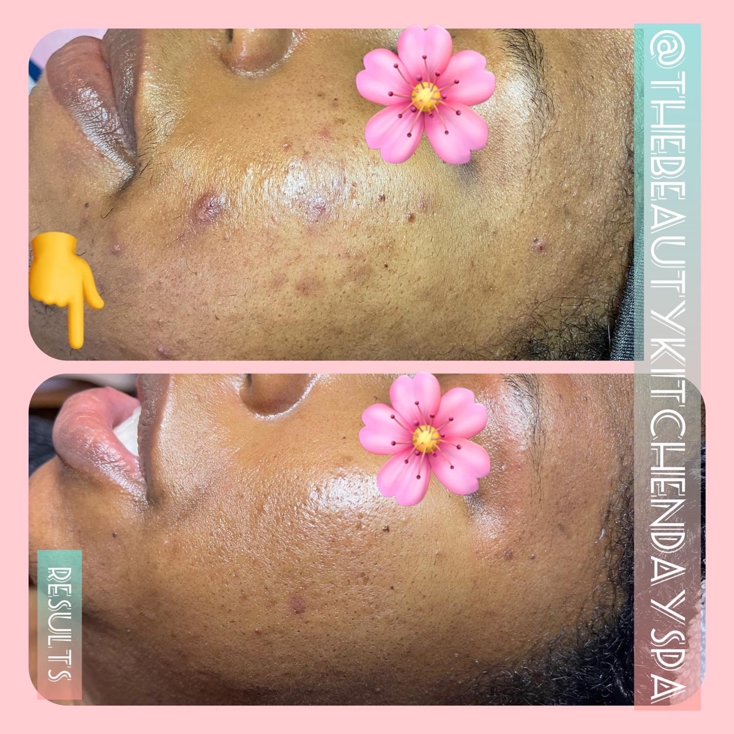 Acne Clear-Up Treatments