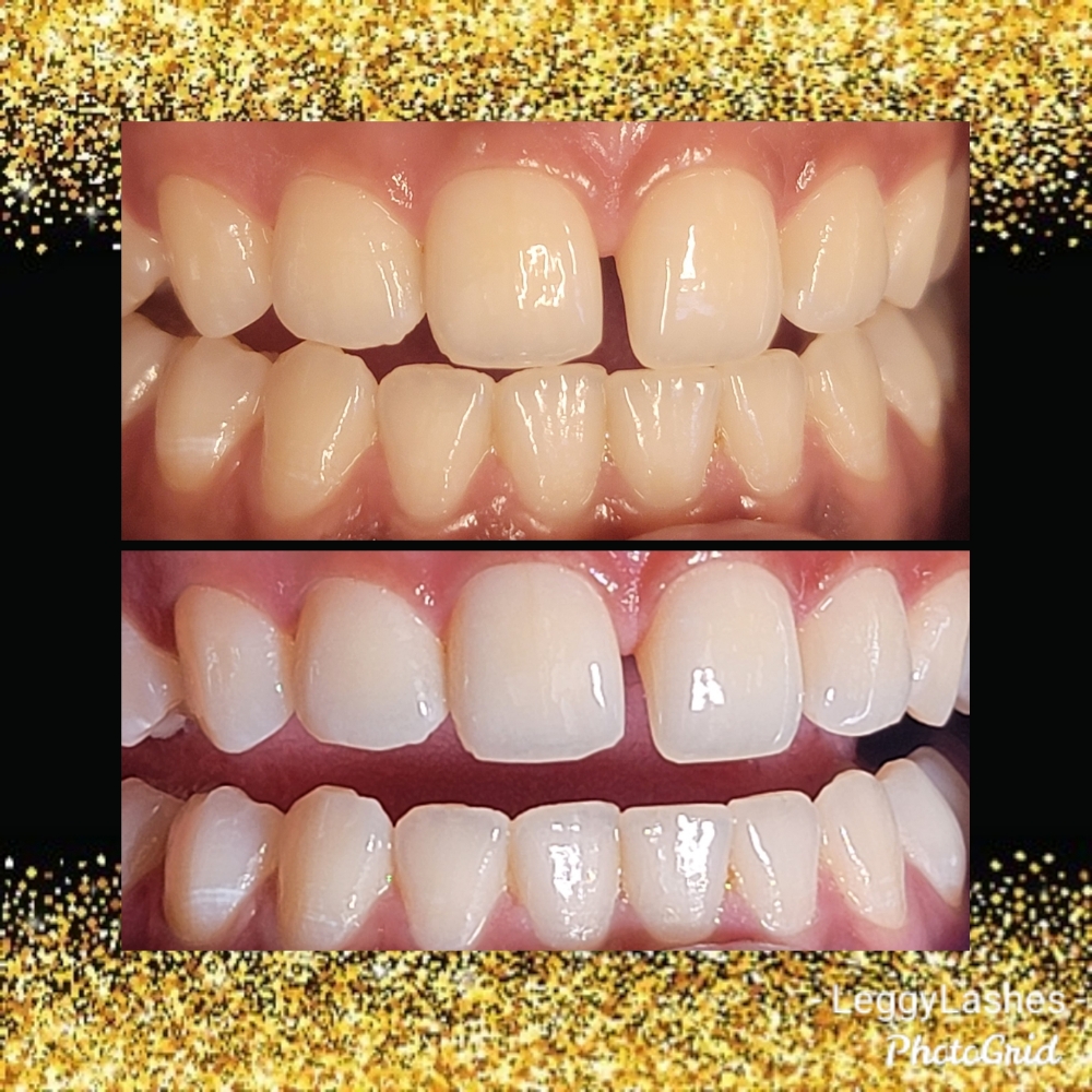 20 Minute Zoom Teeth Whitening