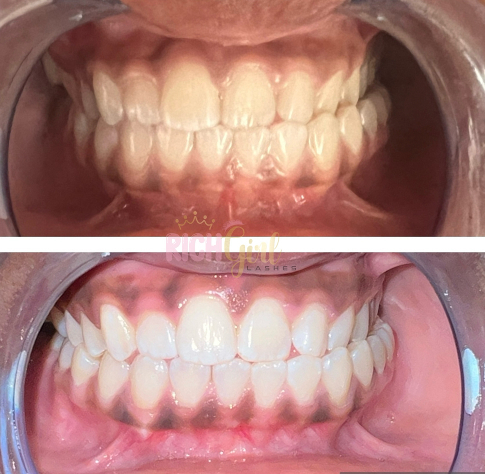 60 Min Teeth Whitening