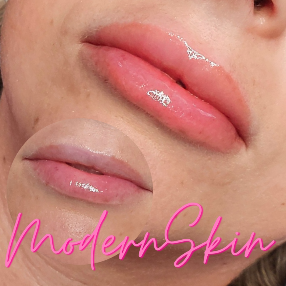 ANNUAL LIP BLUSH RETOUCH