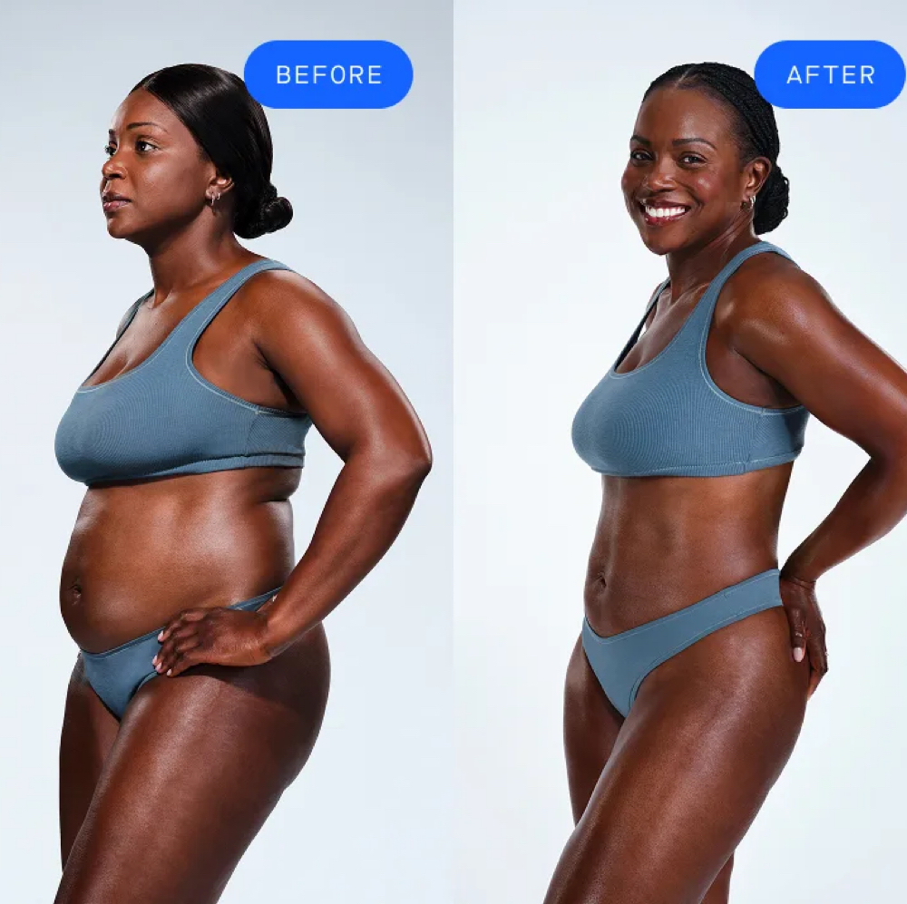 Coolsculpting at Chatuge Med Spa & Fitness in Hiawassee, GA