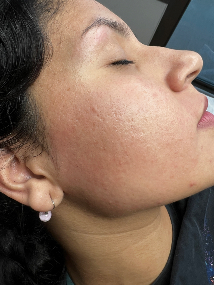 Full Face Threading