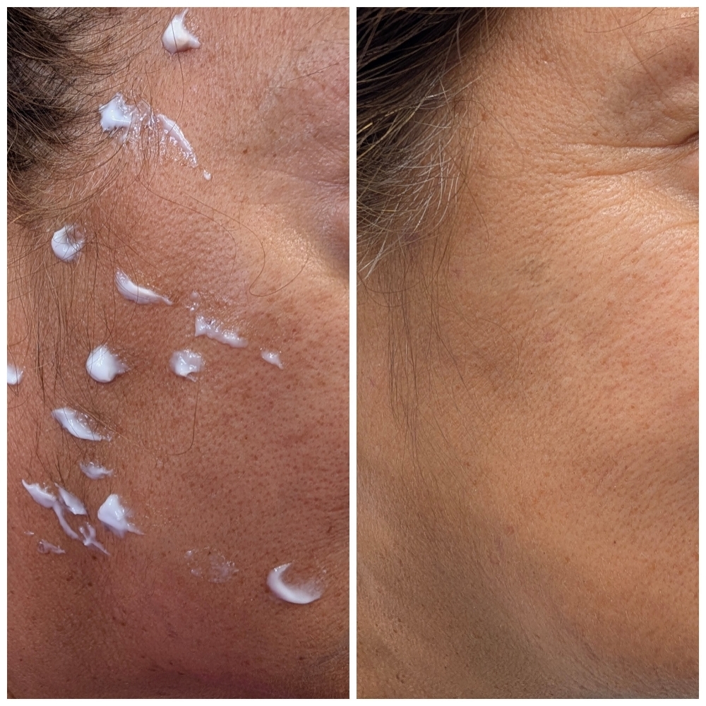 Skin Tag Removal at Essentials by Rose in El Paso, TX