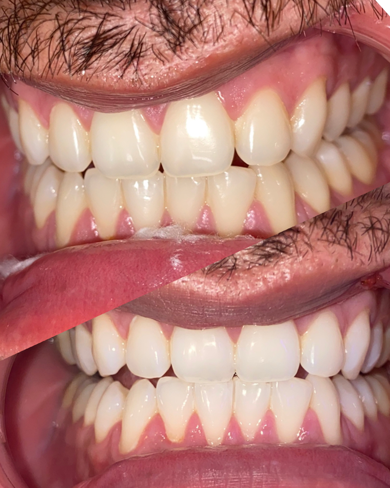 Icy Summer 1hr Teeth Whitening
