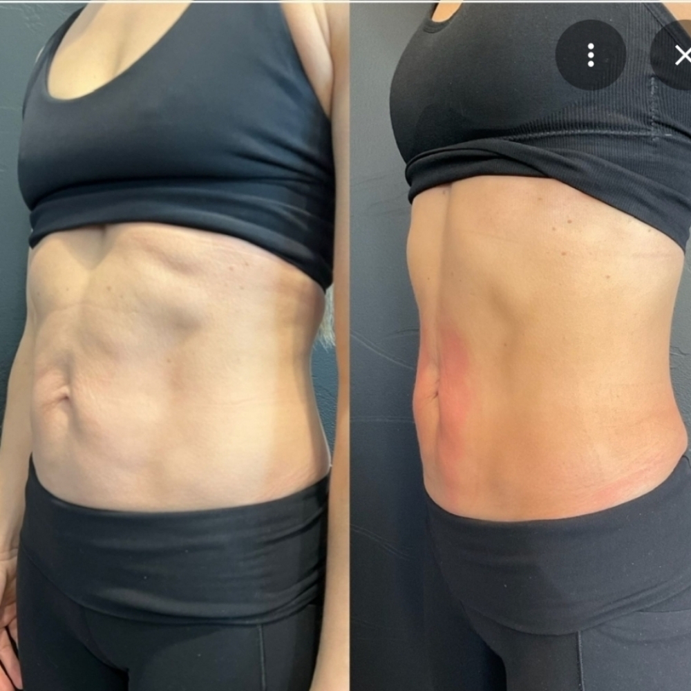 Emsculp at Karisma Esthetics in Melbourne, FL