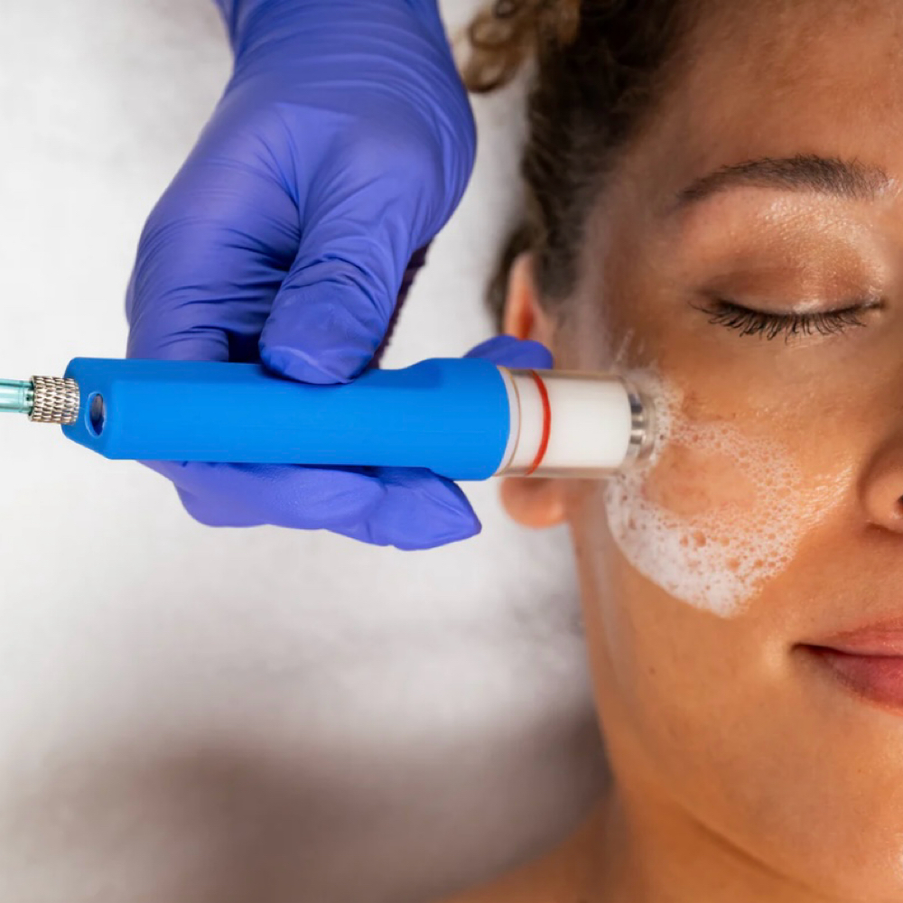 Hydro-Dermabrasion Deluxe at anasko skin studio in Dallas, TX