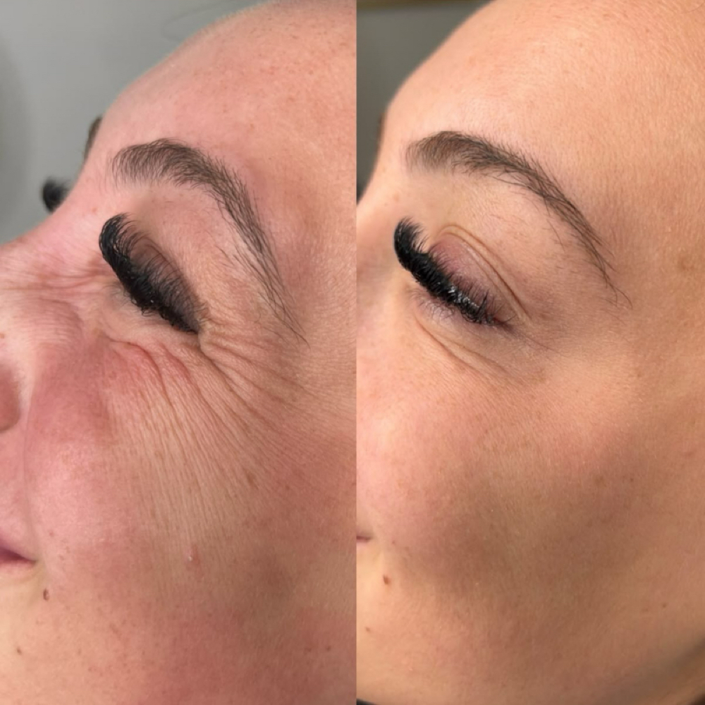 Crows Feet at Lilli Aesthetics LLC in Mansfield, TX