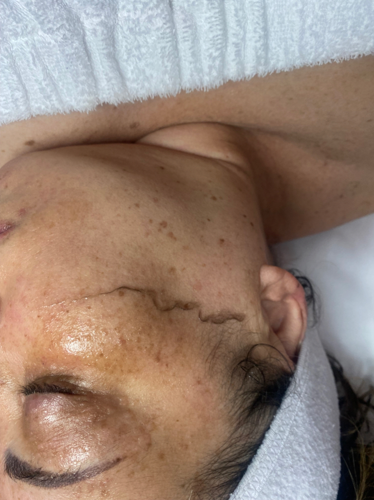 Dermaplane  Facial