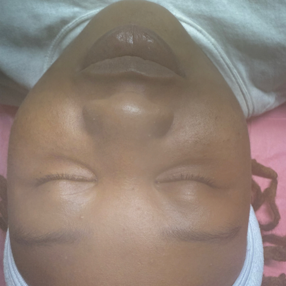 Teen Facial at Skin Clarity Aesthetics in Atlanta, GA