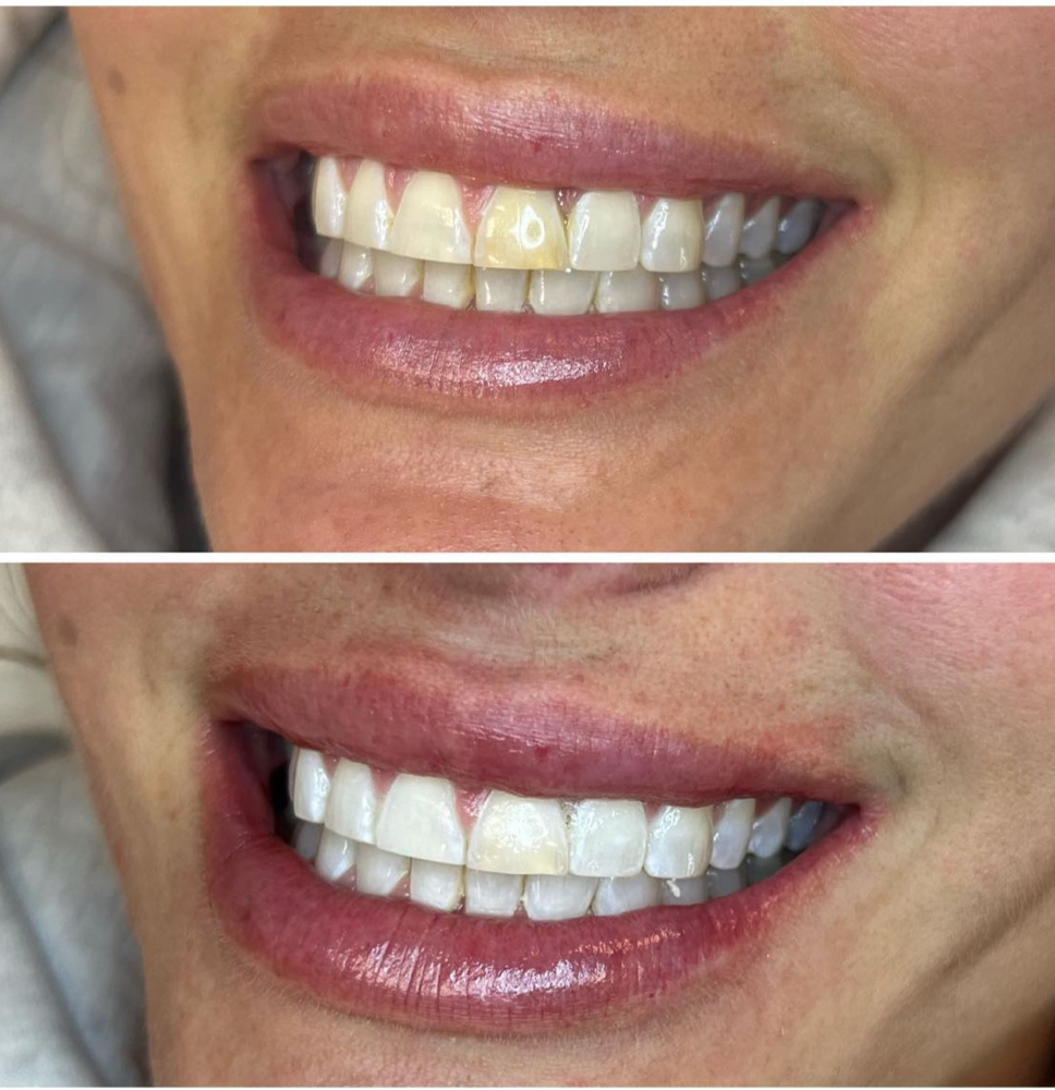 Luxury Teeth Whitening