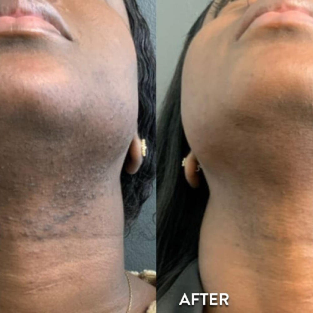 Neck Laser - 5 Sessions at Blessed & Bare Laser Studio in New York, NY