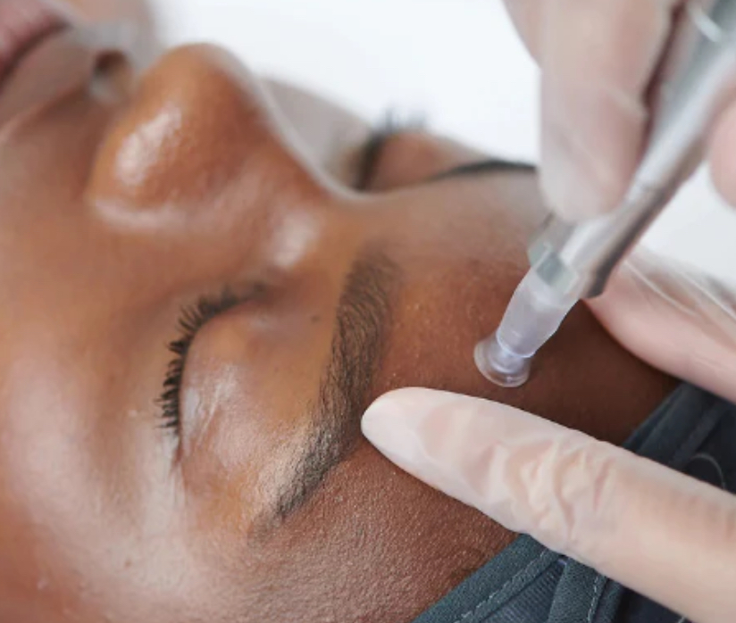 Microneedling Treatments