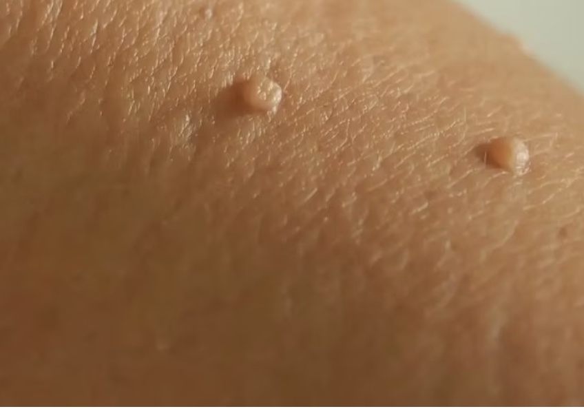 Skin Tag Removal
