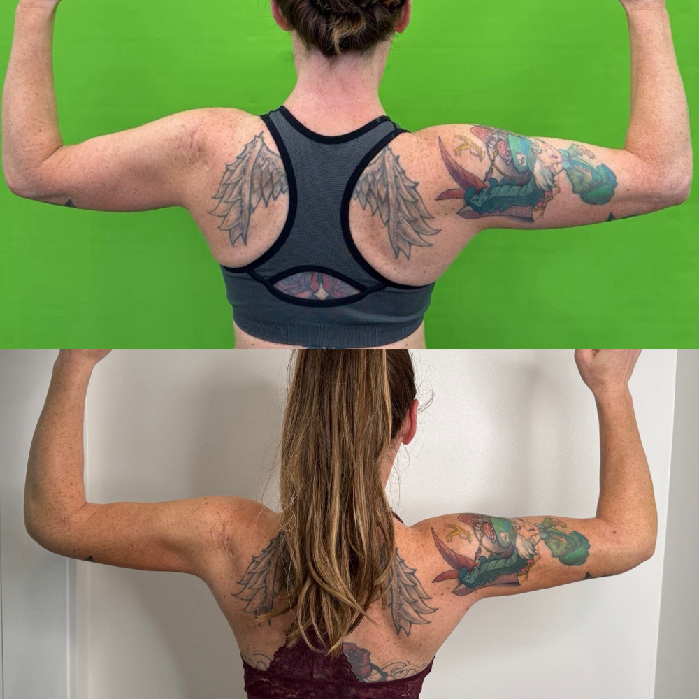 Post-op Arm/Leg at N'Vestd Aesthetics in Fairfeild, OH