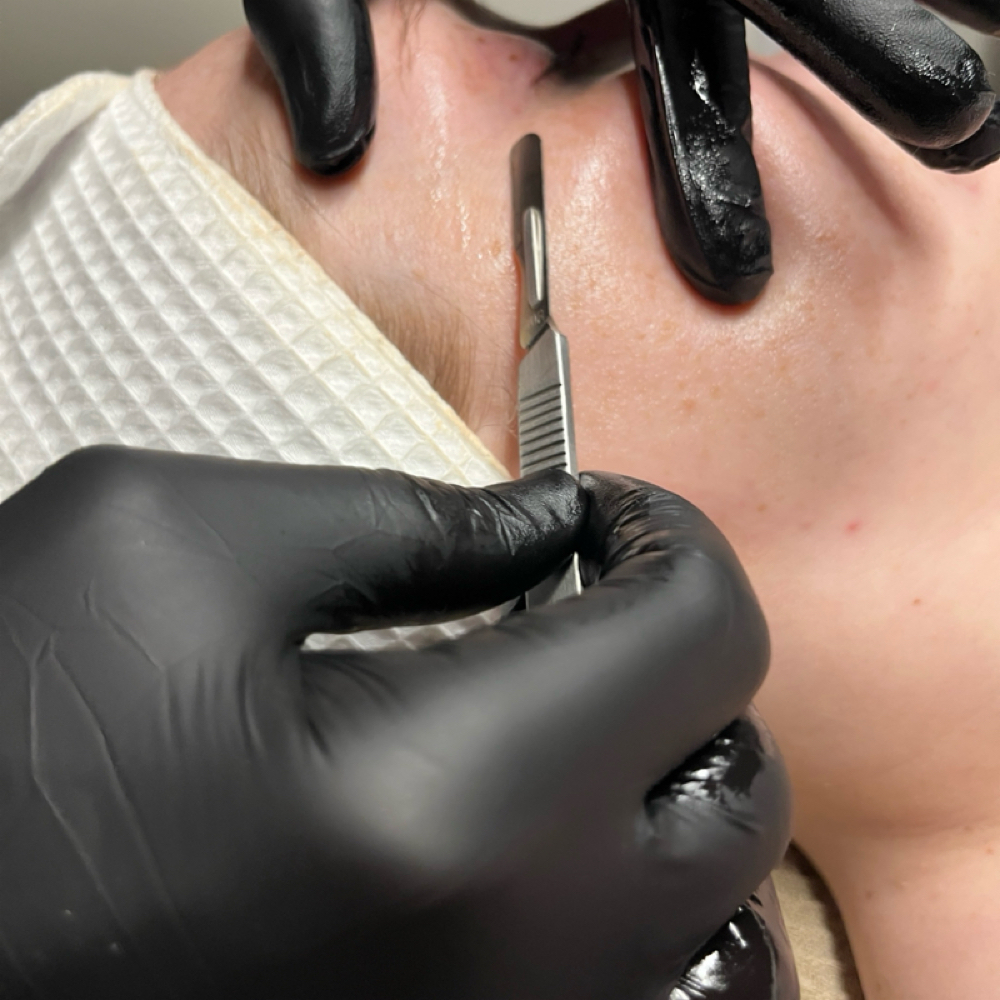 Dermaplaning Treatment at Elegant Esthetics in Virginia Beach, VA