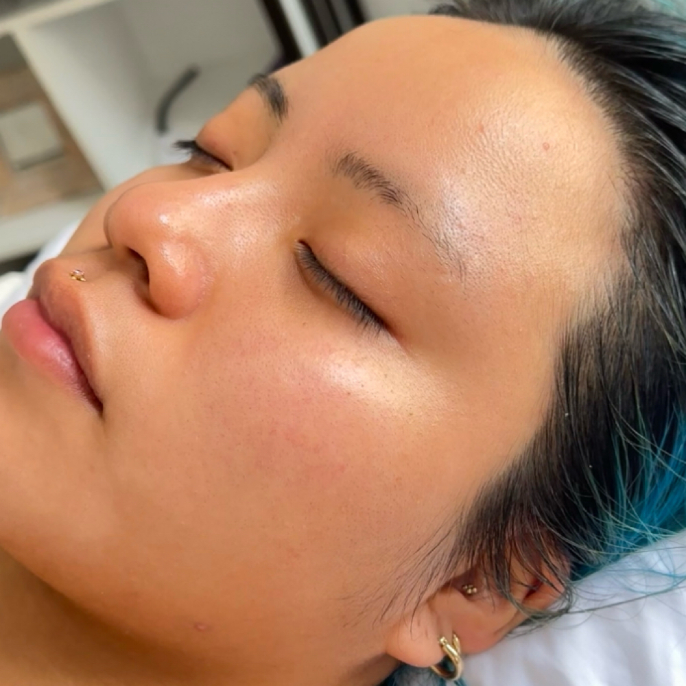 The Renewal Express at Skin Academy in New Bedford, MA