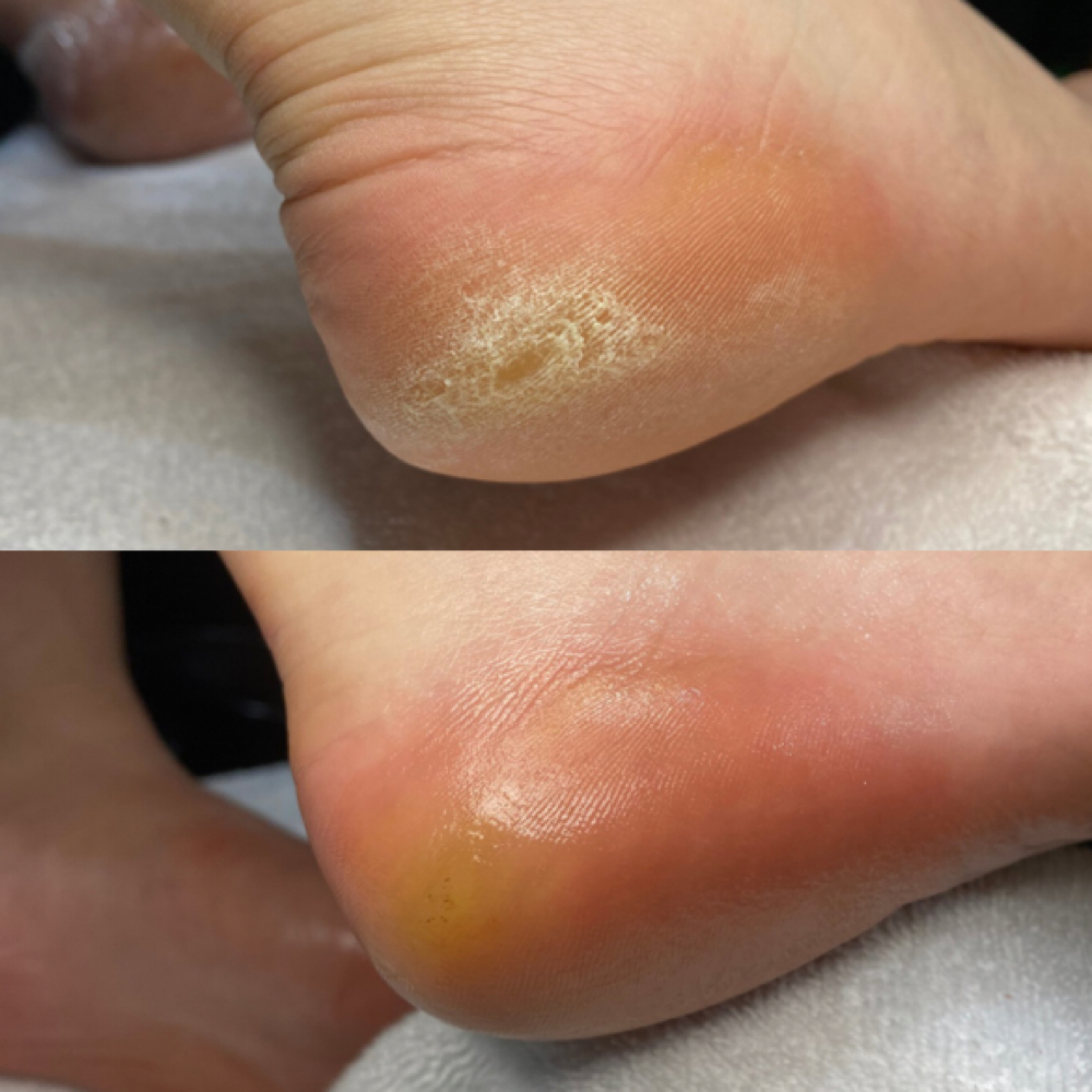 Sa’Sha Heavy Callus Treatment at Shaela Greig in Edina, MN