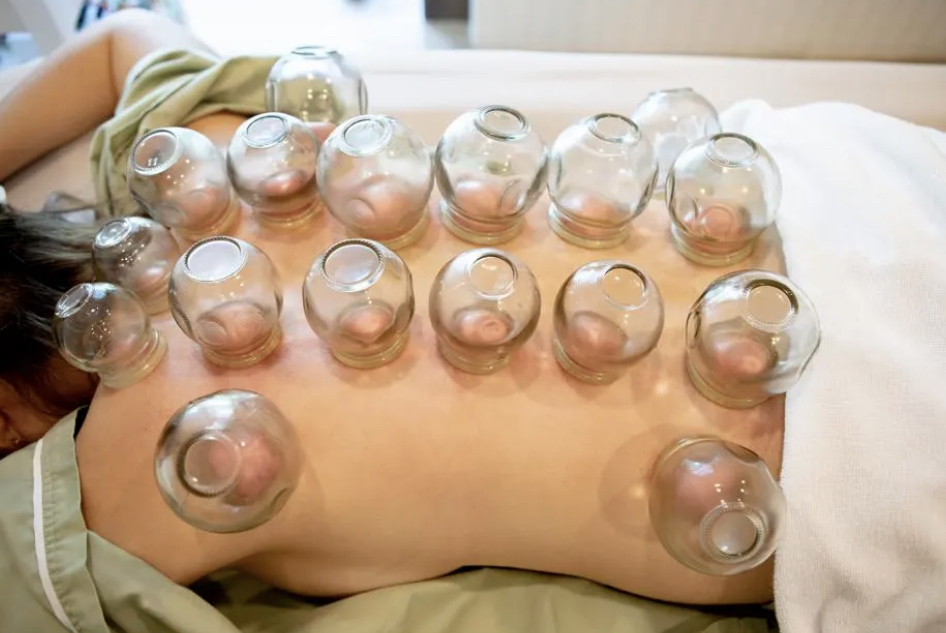 Fire Cupping