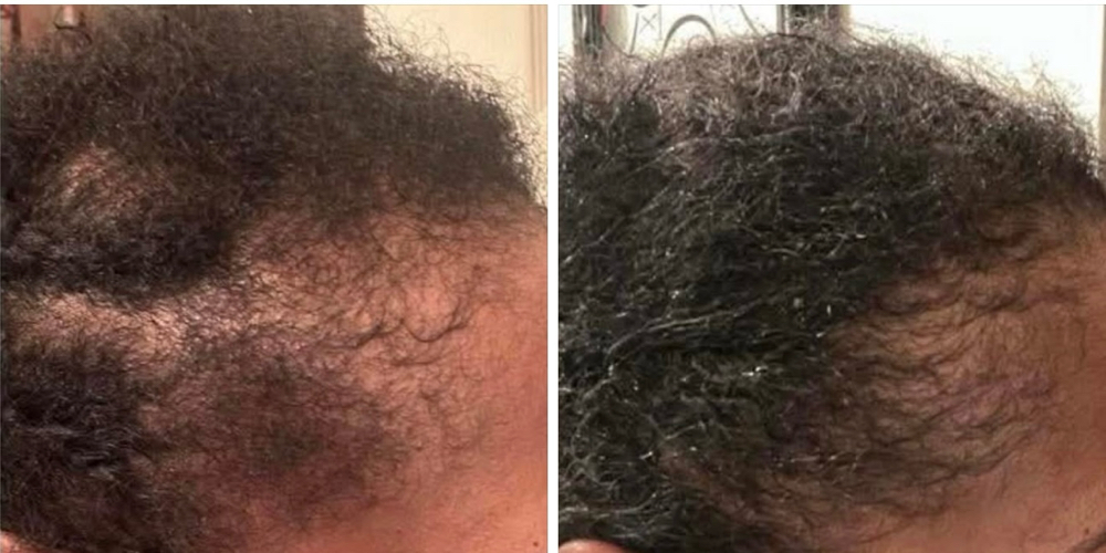 Hair Re-Growth Treatment