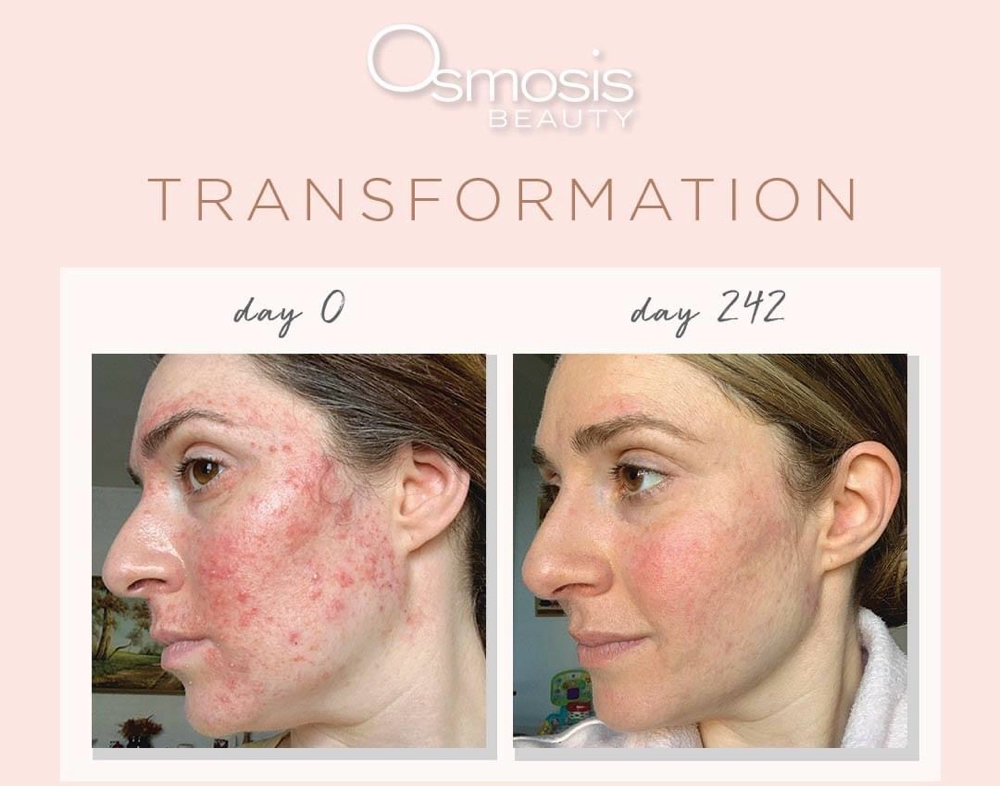 Osmosis Beauty Acne Relief Facial