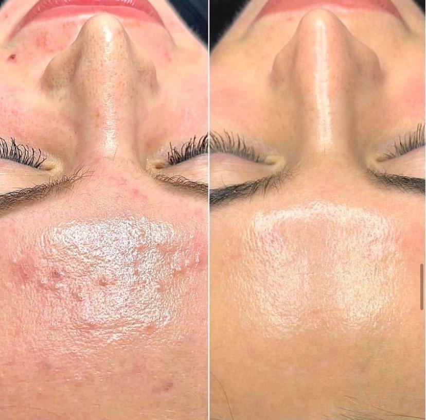 BioRePeel Gold (Body/Face)