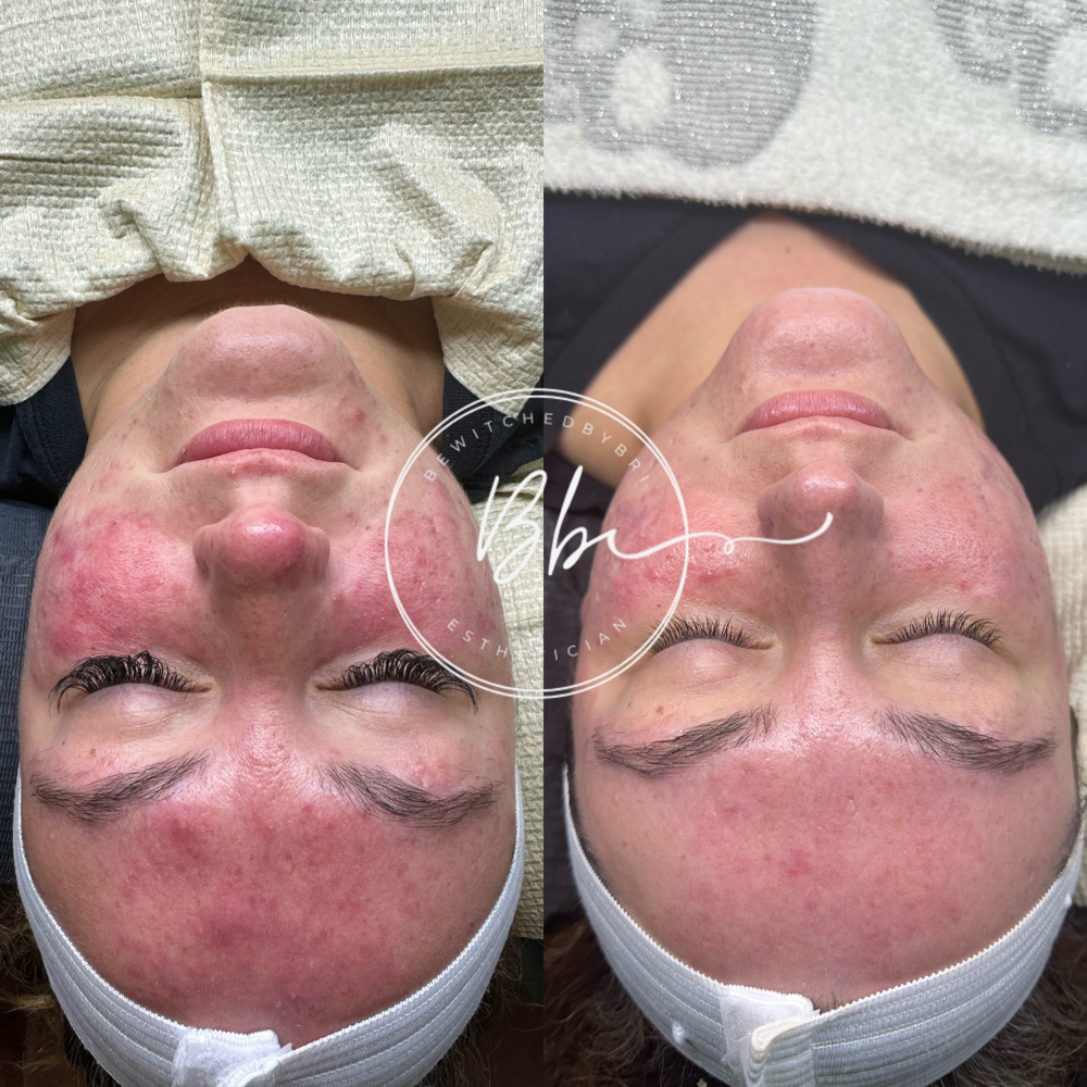 Bio Peel
