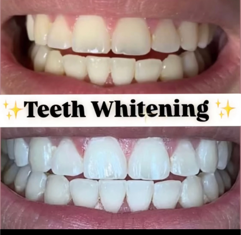Dental Grade Teeth Whitening at Beauty by YaMeL in Santa Ana, CA