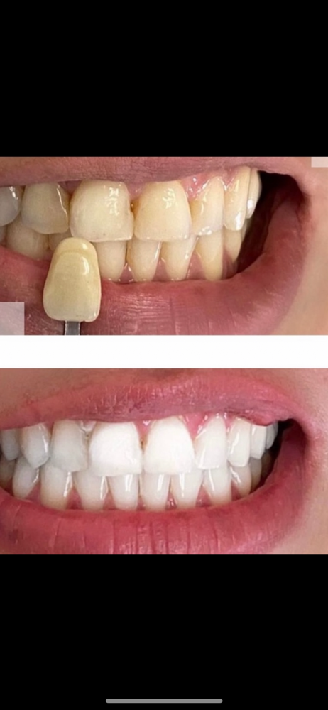 Professional Teeth Whitening
