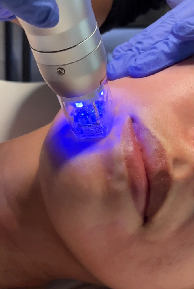 Scarlet RF Microneedling Face