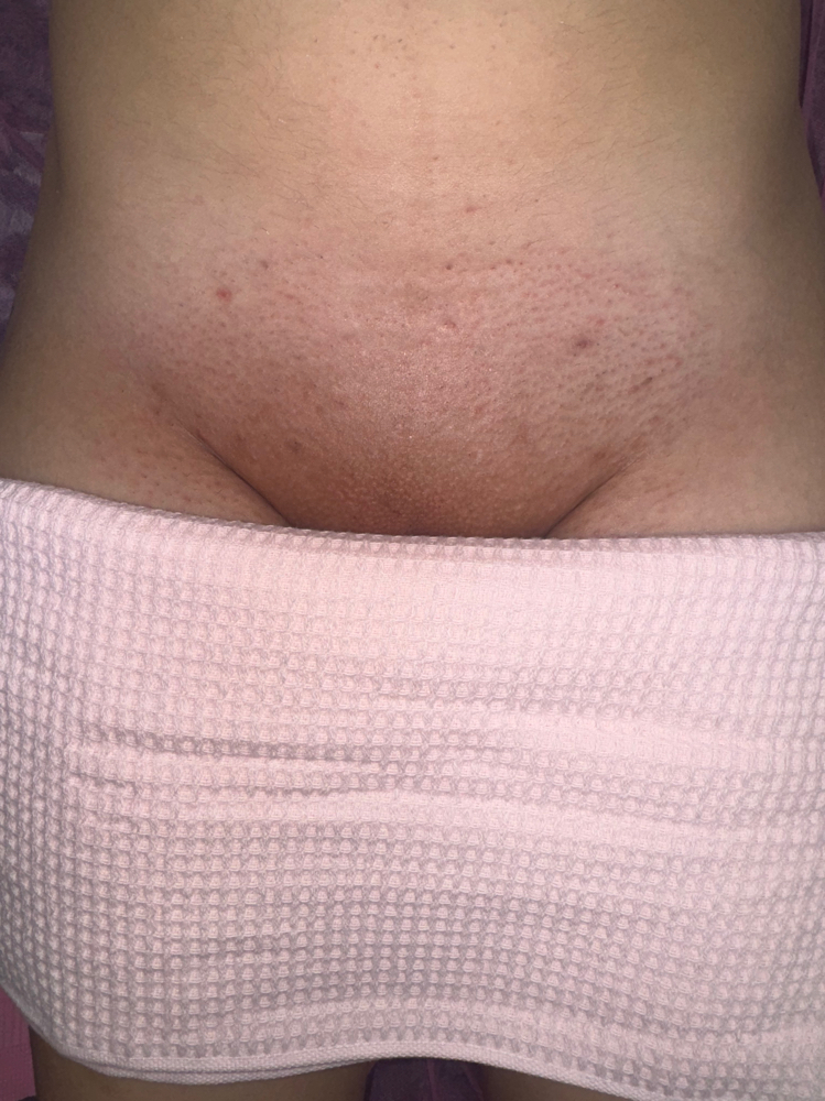 Brazilian Wax at MLN Esthetics in West Springfield, MA