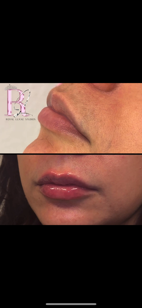 Hyaluron Lip Filler 0.5ML at Royal Luxxe Studios in Colleyville, TX