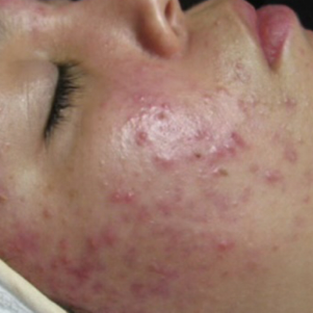 acne program consult + treatment at 828aesthetics in Henderson, NV