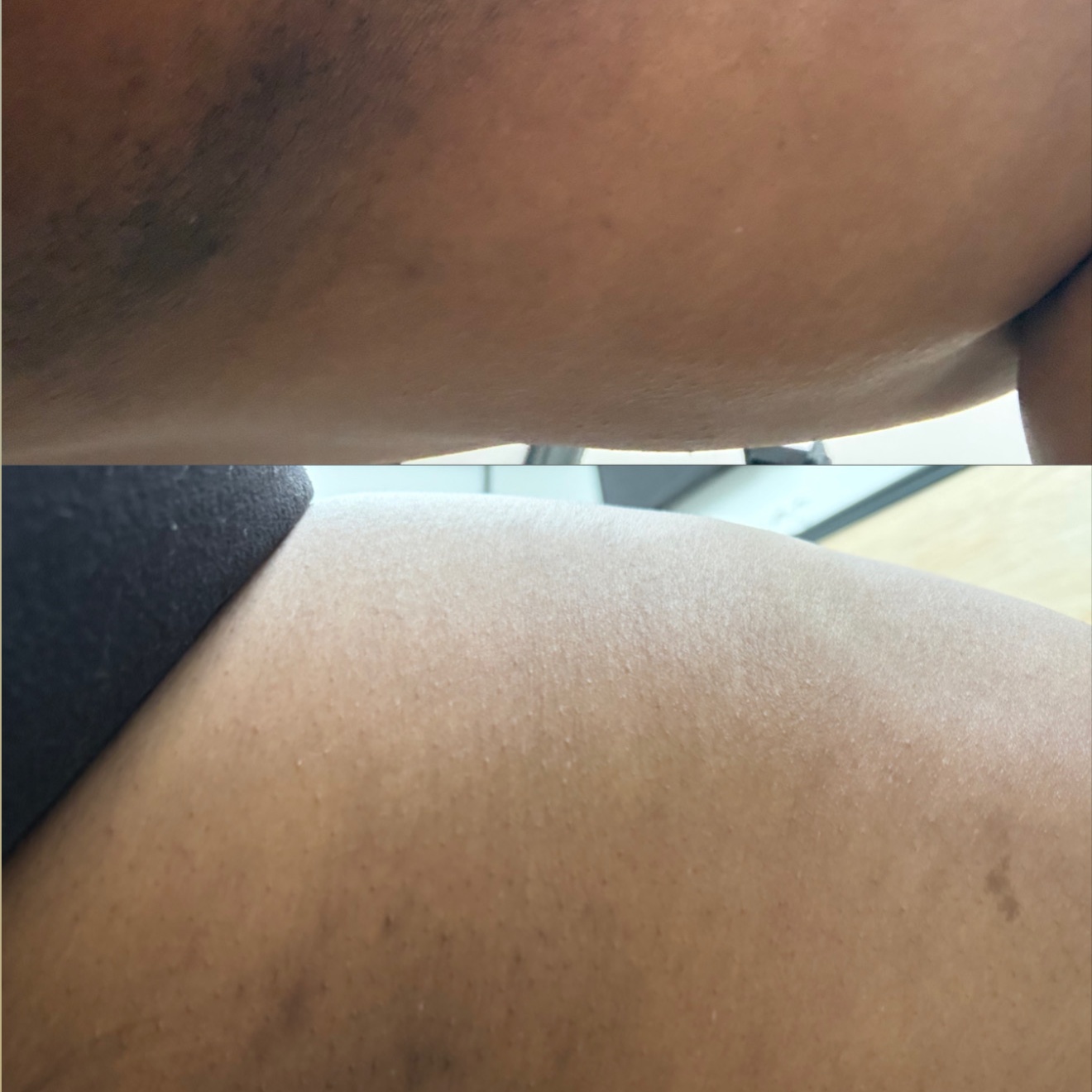New | Inner Thigh Brightening at Velnaira in Lakewood, CA