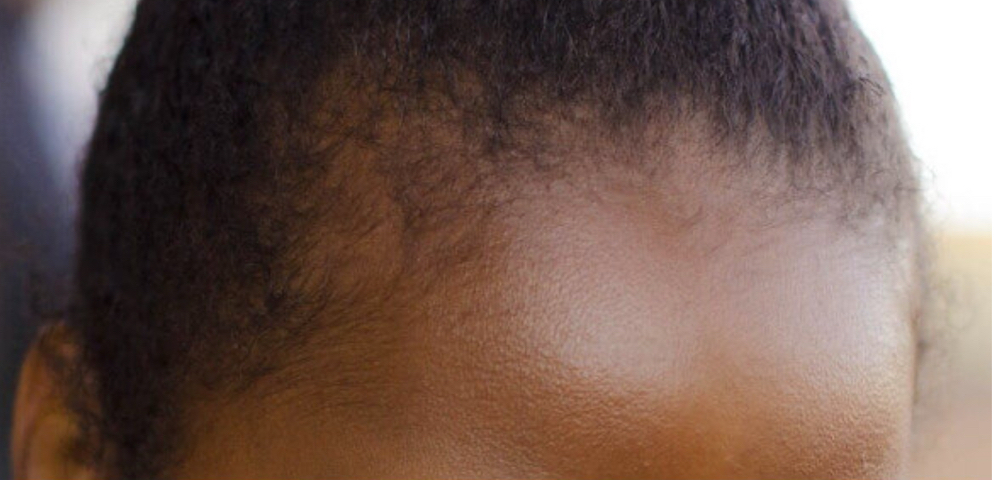 Hairline