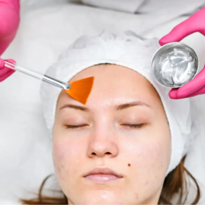 TCA Peel - Face at Sophiesticated Esthetics in Miami, FL