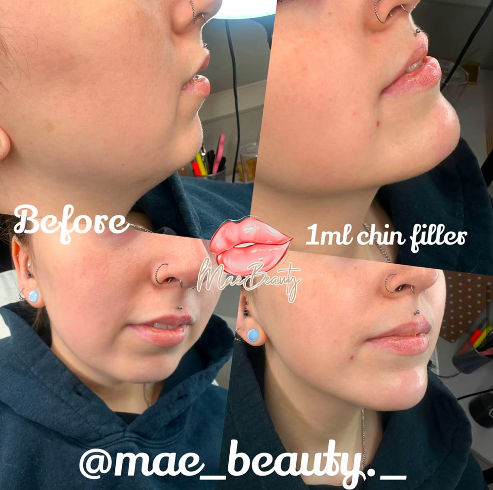 Chin Filler Enhancement at MaeBeauty in Mesquite, TX
