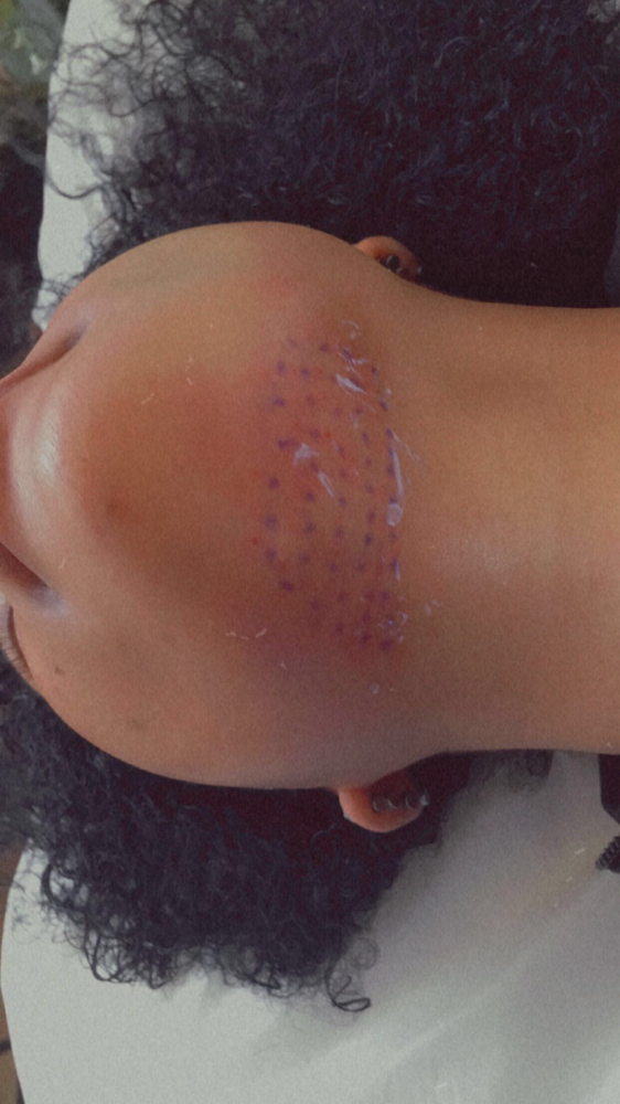 Fat Dissolving  Deal Any Area at DopeGirlz Beauty Spa Academy in Columbus, OH