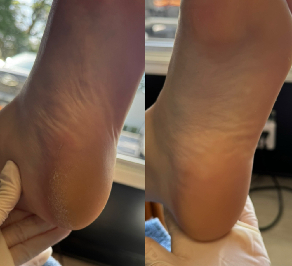 Callus Treatment