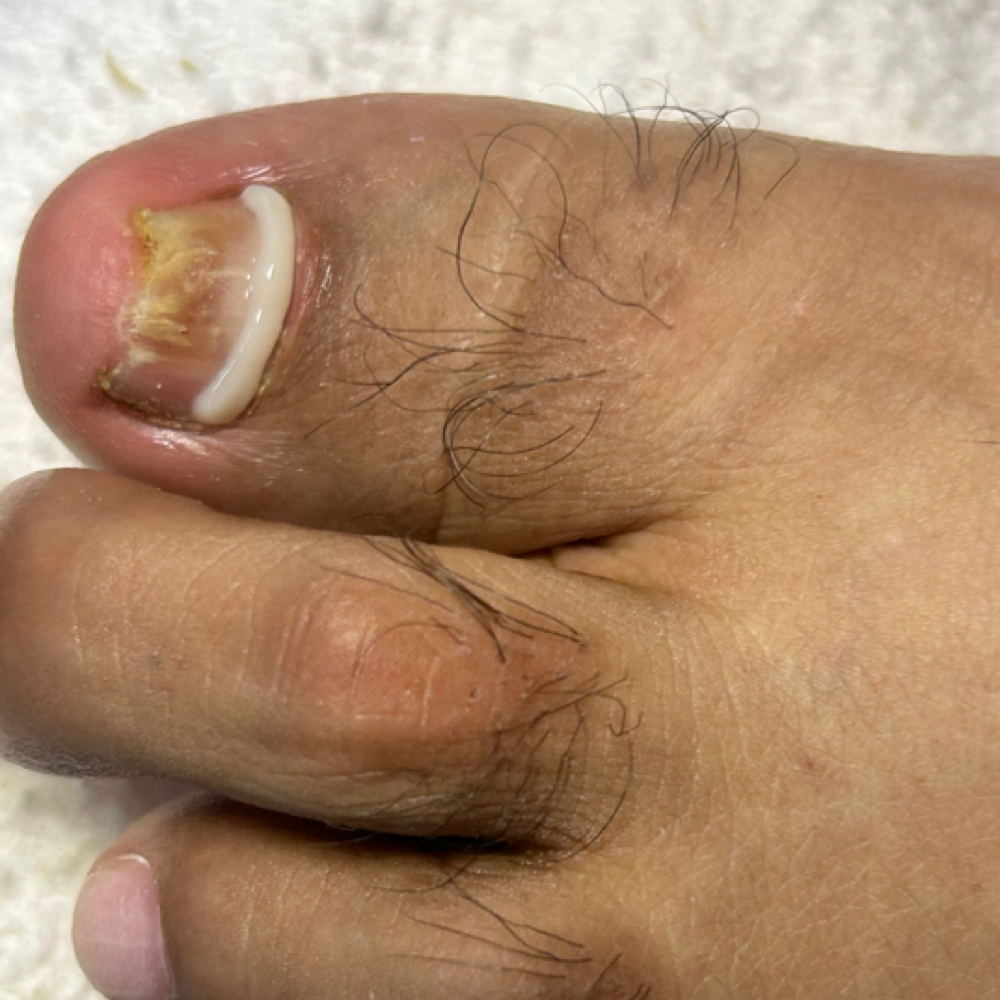 ONYFIX INVOLUTED/INGROWN at Viva De Beauty Pink Haus in Arlington, TX