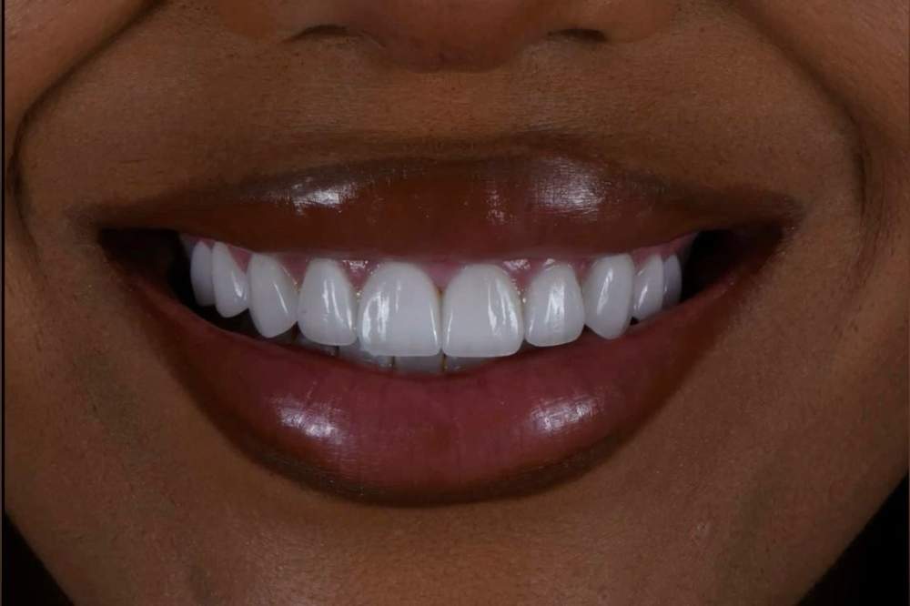 Teeth Whitening