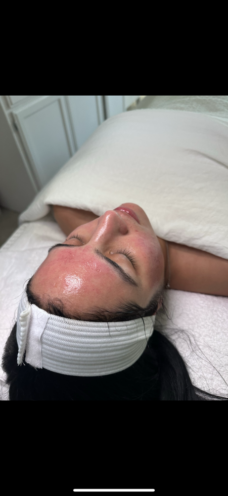 Microneedling Deluxe
